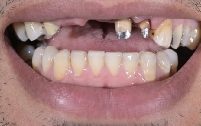Vue intrabuccale avant traitement : dents antérieures délabrées et édentement