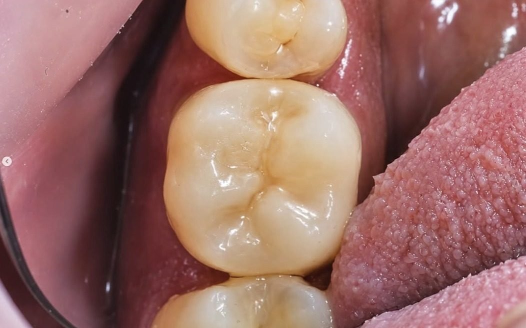 Ceramic crown fitted on the implant, view from above
