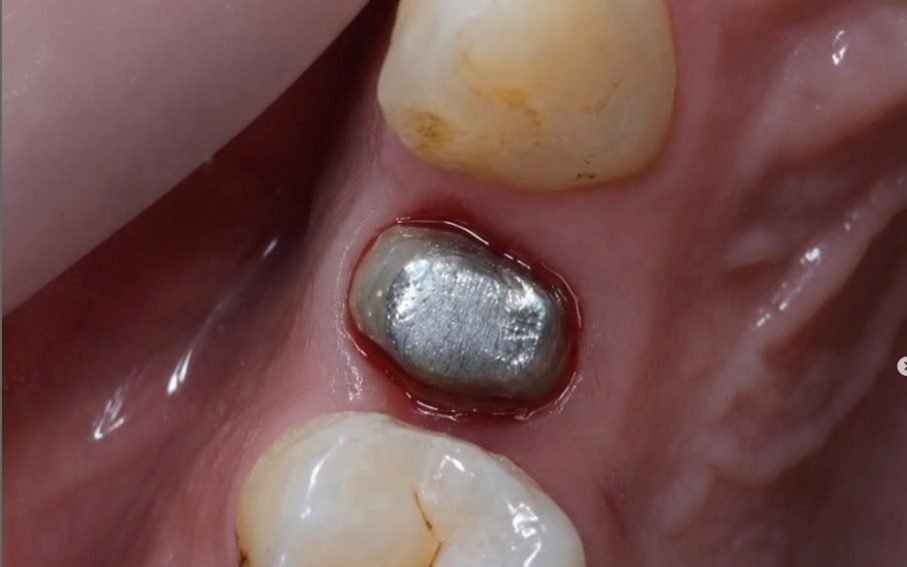 Implant abutment in place at the back of the mouth