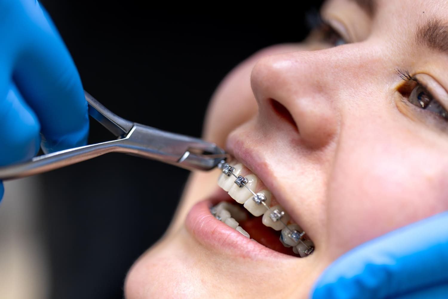 Réglage d’un arc sur un appareil orthodontique multi-attaches