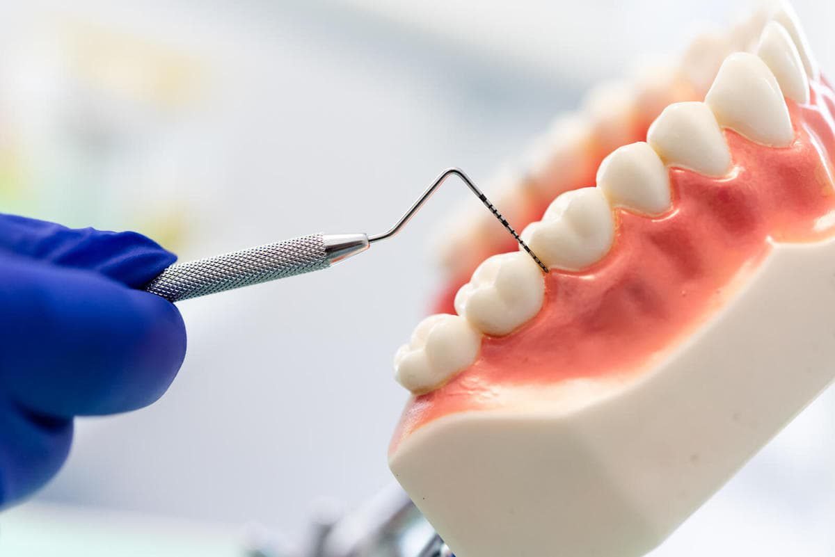 Sonde parodontale mesurant la profondeur du sillon gingival sur un modèle