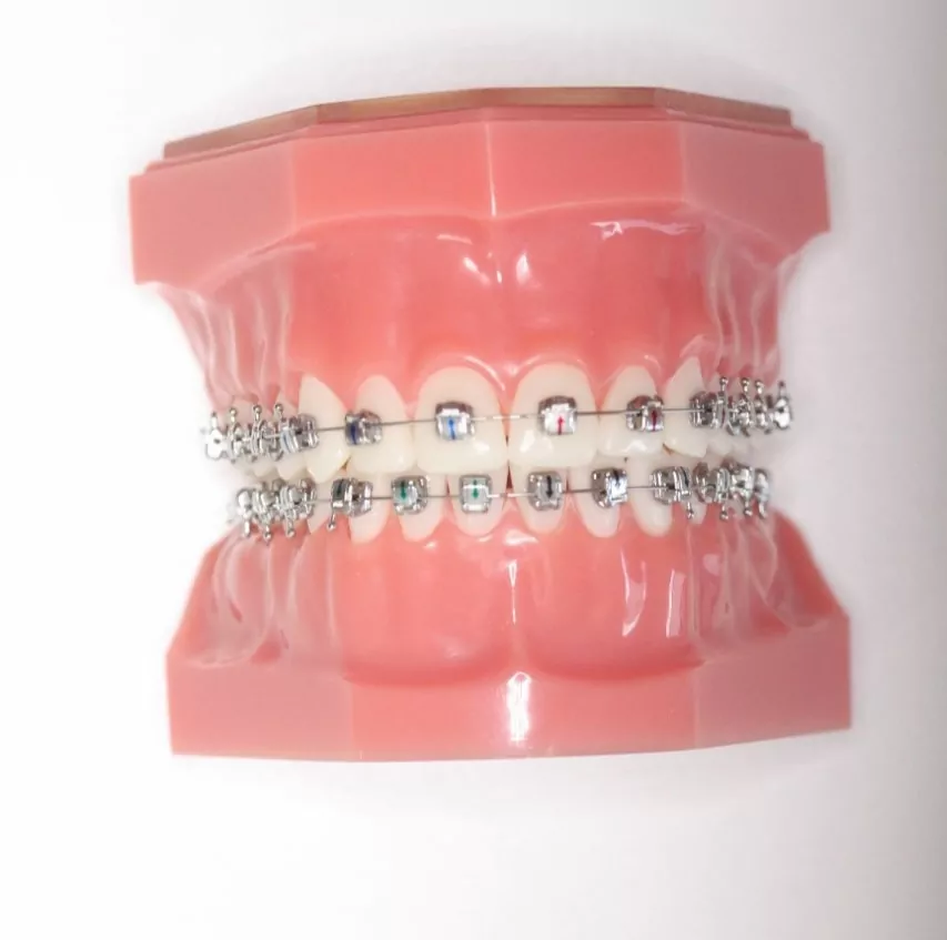 Traitement en orthodontie classique avec bagues