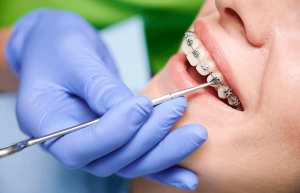 Orthodontie classique avec bagues métalliques