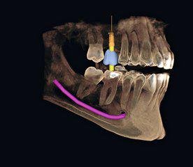 Cone Beam