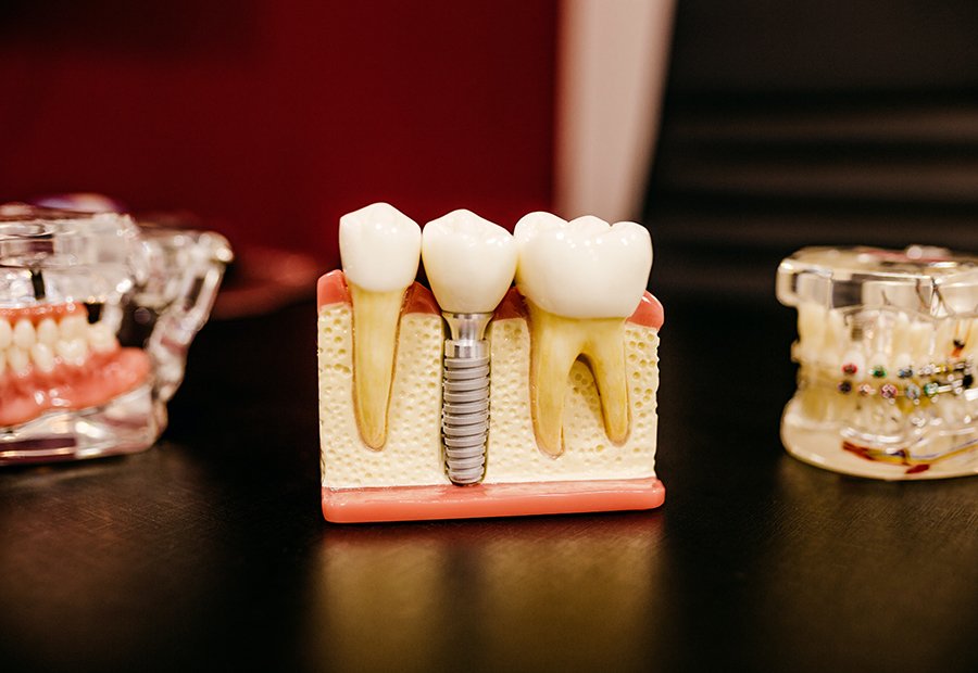 Prothèse stabilisée
